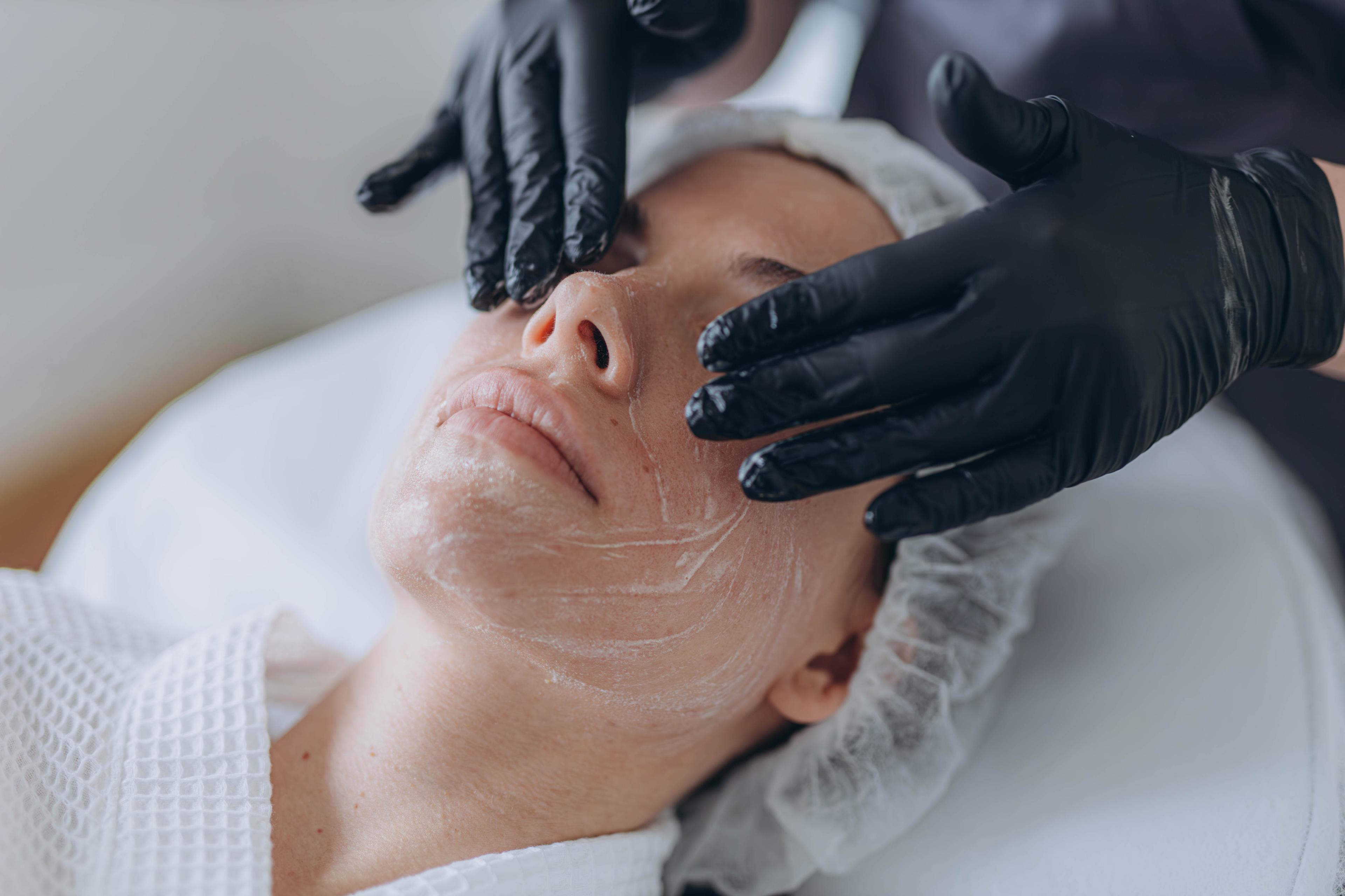 Chemical Peels result 2