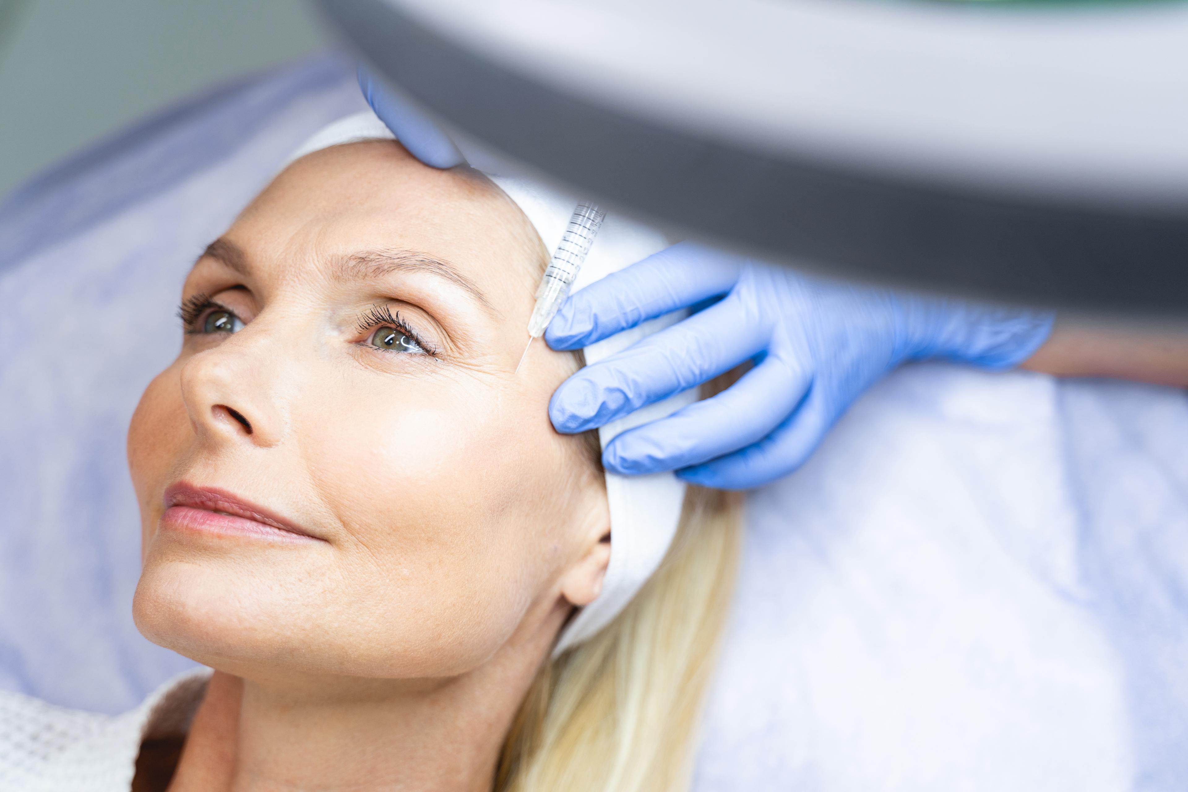 Fibroblast Skin Tightening result 2