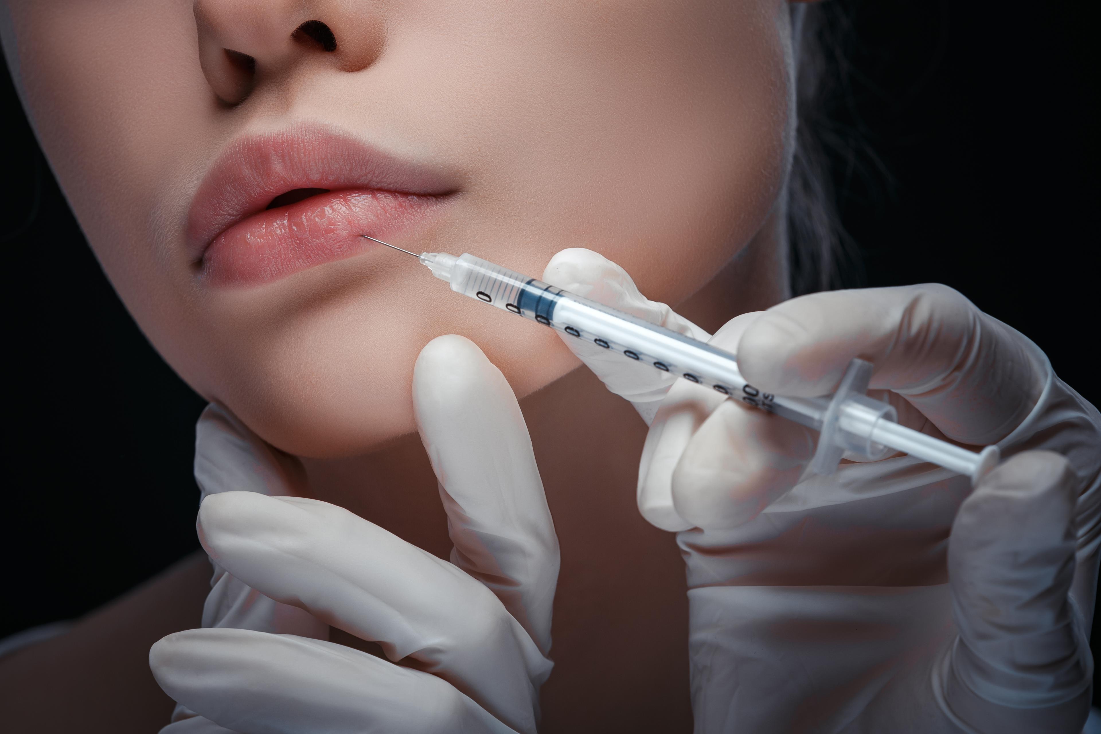 Lip Filler result 1